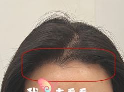 -大麦微针植发全国连锁