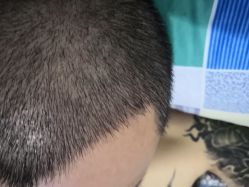 -大麦微针植发丨全国连锁