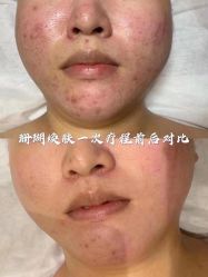 -苗方清颜痘肌研究所