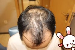 -大麦微针植发丨全国连锁