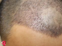 -大麦微针植发丨全国连锁