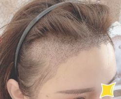 -大麦微针植发丨全国连锁