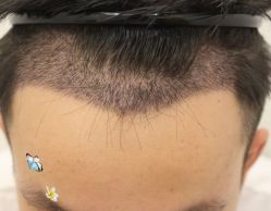 -大麦微针植发丨全国连锁