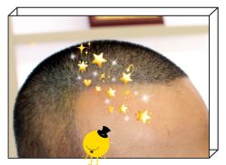 -大麦微针植发全国连锁