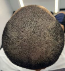 体验后-大麦微针植发全国连锁