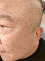 体验前-北京美痣堂古方祛痣斑疣瘊