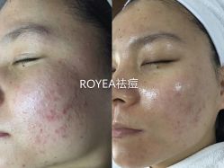 点击看大图 -ROYEA茹彦祛痘·问题肌肤修护中心