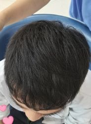 -大麦微针植发丨全国连锁