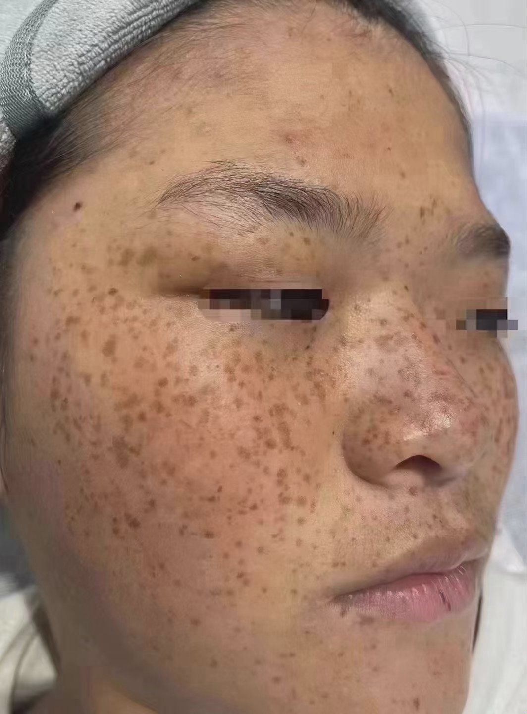 雀斑是发生在面部皮肤上黄褐色点状色素沉着