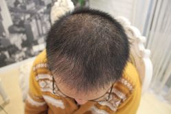 点击看大图 -大麦微针植发丨全国连锁