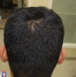 -大麦微针植发丨全国连锁