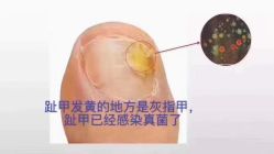 -德哥灰指甲脚气甲沟炎跖疣护理
