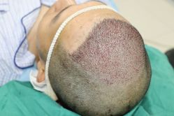 -大麦微针植发丨全国连锁