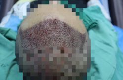 -大麦微针植发全国连锁