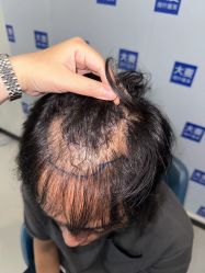 -大麦微针植发丨全国连锁