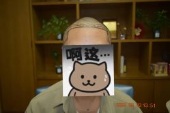 体验前-大麦微针植发全国连锁