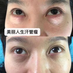 -爱莎扁平疣·汗管瘤·斑痣中心