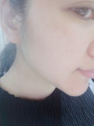 体验后-洁铭新加坡医美