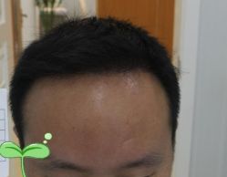 -大麦微针植发丨全国连锁