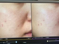 体验后-苑苑vbeauty科技美容SPA