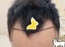 -大麦微针植发全国连锁