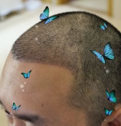 -大麦微针植发丨全国连锁