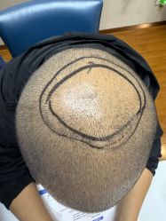 -大麦微针植发全国连锁