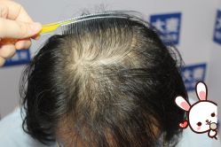 -大麦微针植发丨全国连锁