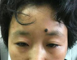 点击看大图 -北京美痣堂古方祛痣斑疣瘊