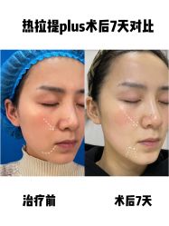 -蚌埠国色医疗美容医院•眼鼻整形