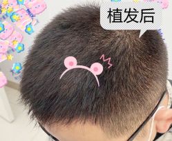 -大麦微针植发全国连锁