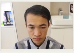 -大麦微针植发全国连锁