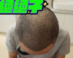 -大麦微针植发丨全国连锁