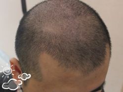 -大麦微针植发丨全国连锁