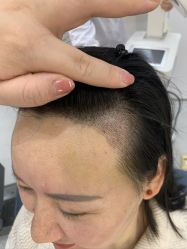 -大麦微针植发全国连锁