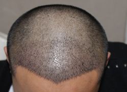 -大麦微针植发全国连锁