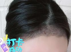 -大麦微针植发全国连锁