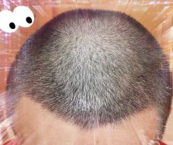 -大麦微针植发全国连锁