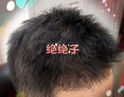 -大麦微针植发全国连锁