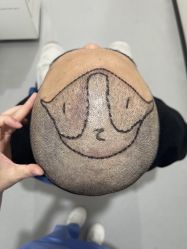 -大麦微针植发全国连锁