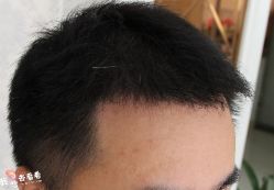 -大麦微针植发丨全国连锁