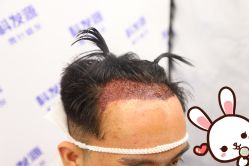 -大麦微针植发丨全国连锁