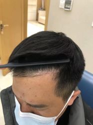 点击看大图 体验后-大麦微针植发丨全国连锁