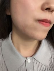 -爱莎扁平疣·汗管瘤·斑痣中心
