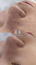 -痘庄科学祛痘国际连锁