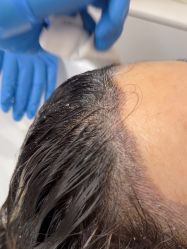 -大麦微针植发全国连锁