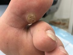 -世龙世家灰指甲·甲沟炎·跖疣护理·修脚(东江湾路店)