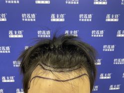 -碧莲盛·不剃发植发
