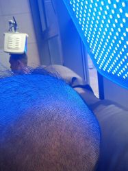 -碧莲盛·不剃发植发