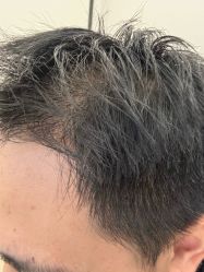 -大麦微针植发丨全国连锁